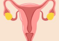 Does a Hysterectomy Cure PCOS?