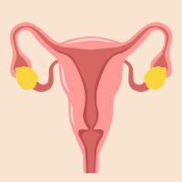 Does a Hysterectomy Cure PCOS?