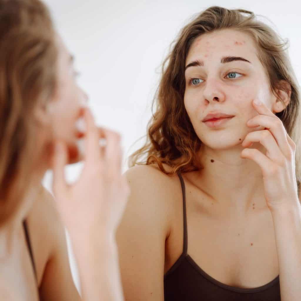 Treating Acne from PCOS Treating Acne from PCOS