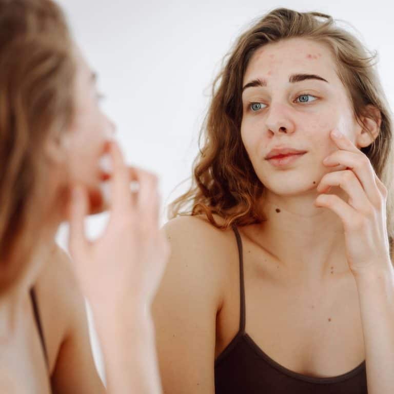 woman looking in the mirror at her acne