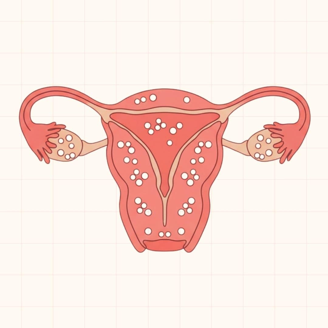8 Types of Abnormal Menstruation Common with PCOS Explained