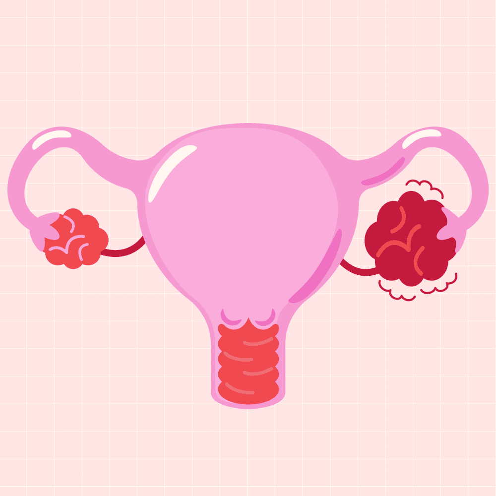 Does PCOS Cause Infertility_ What Doctors Don’t Always Explain
